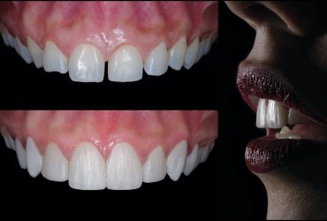 Estética Dental