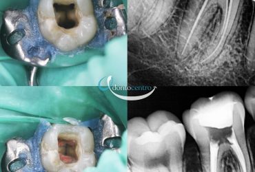 Endodoncia