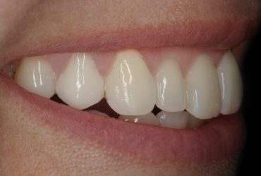 Rehabilitación Oral